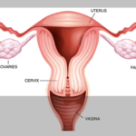 Total Hysterectomy