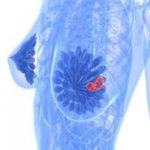 Breast Cancer Screening by Mammogram