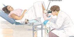 Colposcopy-examine-cervix